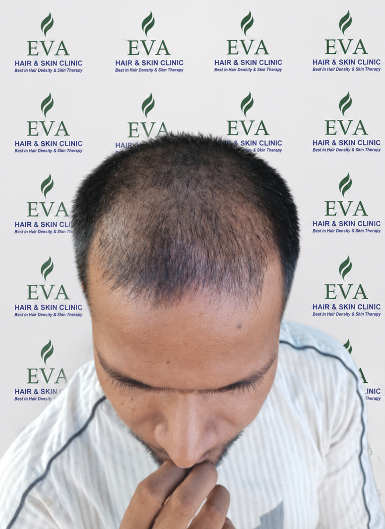 Before hair transplant result 10